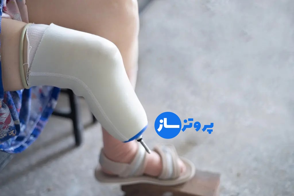 لاینر در قطع عضو زیر زانو