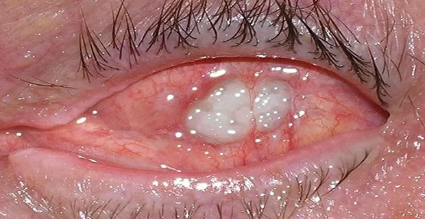 علل نیاز به تخلیه چشم