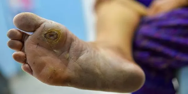 عوامل افزایش خطر قطع عضو دیابتی