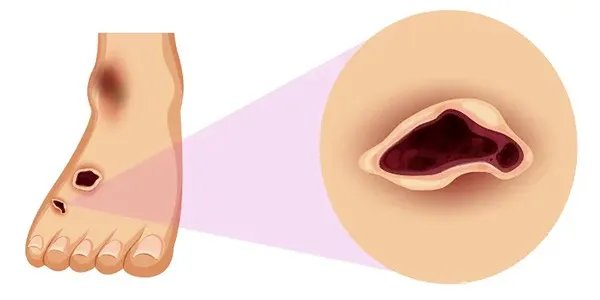 زخم پای دیابتی در مراحل اولیه