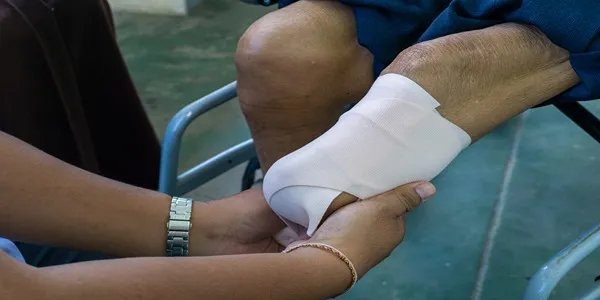 پیشگیری از انقباض عضلانی بعد از قطع پا