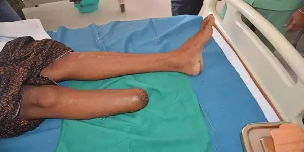 قطع عضو در تصادف