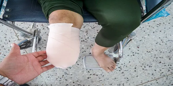 مدیریت درد فانتوم پس از قطع پا