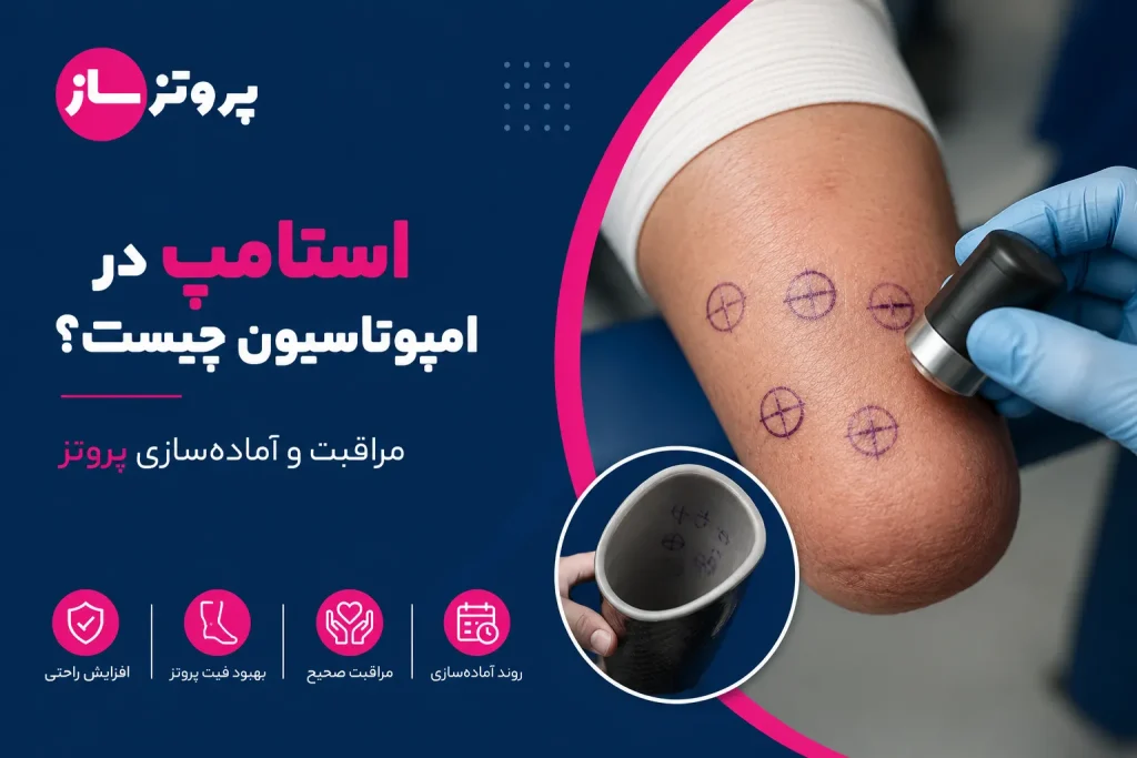 استامپ در امپوتاسیون