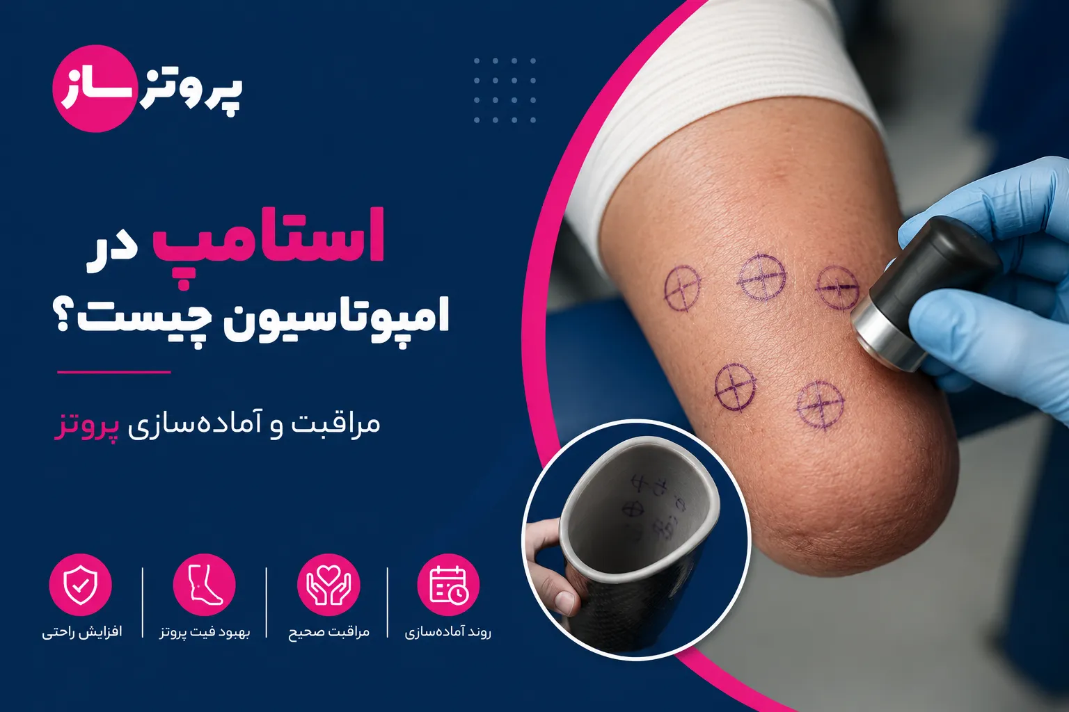 استامپ در امپوتاسیون